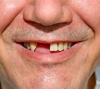 Image result for Guy Missing Jaw