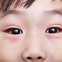 Image result for Allergic Conjunctivitis Treatment