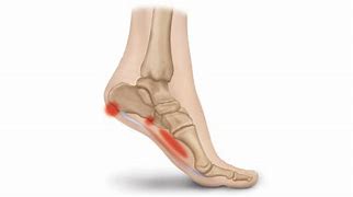 Image result for Plantar Fascia Ligament Pain