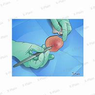 Image result for Cyst Removal Surgery