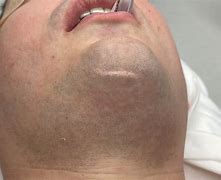 Image result for Scar On Chin