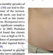 Image result for Ilioinguinal Nerve Pain