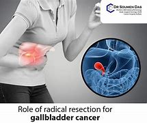 Image result for Radical Resection