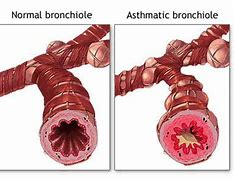 Image result for Lungs of a Person with Asthma