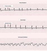 Image result for AFib vs V-fib