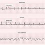 Image result for AFib vs V-fib