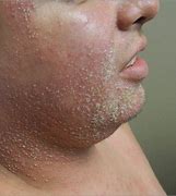 Image result for Viral Pustules