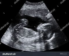 Image result for Baby Ultrasound Photo