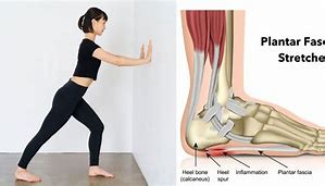 Image result for plantar fasciitis causes