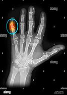 Image result for PA Finger X-ray