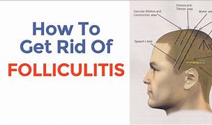 Image result for Bacterial Folliculitis Scalp