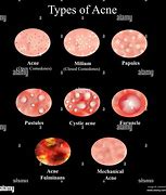 Image result for Pustules Skin Disease