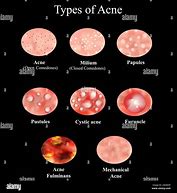 Image result for Pustules and Papules On Face