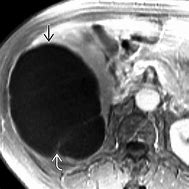 Image result for Complex Liver Cyst