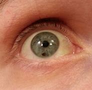 Image result for Face Mole Eye