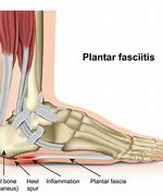 Image result for Plantar Fascia Ligament Pain