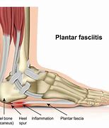 Image result for Heel Pain Plantar Fasciitis Sandals