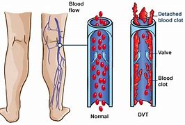 Image result for Venous Thrombosis