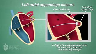 Image result for Thoracoscopic Left Atrial Appendage Clipping