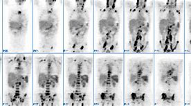 Image result for Pet Scan Lymphoma Example