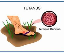 Image result for Tetanus Infected Wound