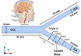 Image result for Internal Carotid Artery Bifurcation