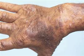 Image result for Eczema On Darker Skin