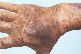 Image result for Eczema On Black Skin with Grey Colour