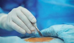 Image result for Cyst Removal Surgery