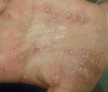 Image result for Psoriatic Pustules