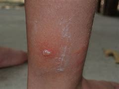 Image result for Scorpion Sting Bite