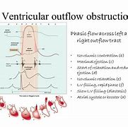 Image result for Right Ventricular Outflow Tract