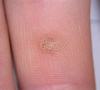 Image result for Plane Warts