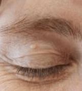 Image result for Flat Warts On Eyelids