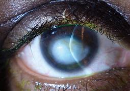 Image result for Corneal Defect