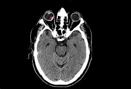 Image result for Orbital Hemorrhage CT