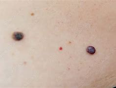 Image result for Benign Skin Bumps