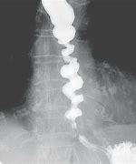 Image result for Esophageal Sphincter Spasm