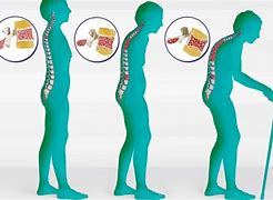 Image result for Osteoporosis Lumbar Spine