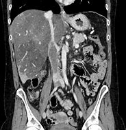 Image result for IVC Thrombs Post-Mortem