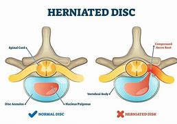 Image result for Lumbar Spine Herniation