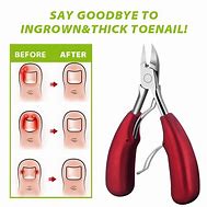 Image result for Ingrown Nail Tool