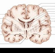 Image result for CT Brain Lentiform Nucleus