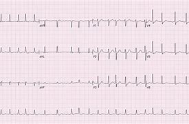 Image result for AFib vs V-fib