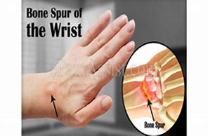 Image result for Bone Spur On Finger