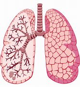 Image result for Lungs of a Person with Asthma