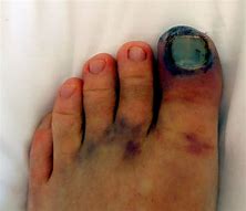 Image result for Broken Toe Bone