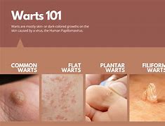 Image result for Flat Skin Warts