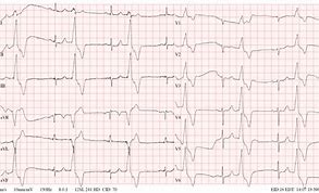 Image result for Bigeminy PVC ECG