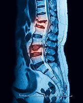 Image result for Imagees Compression Fracture of Lumbar Vertebrae